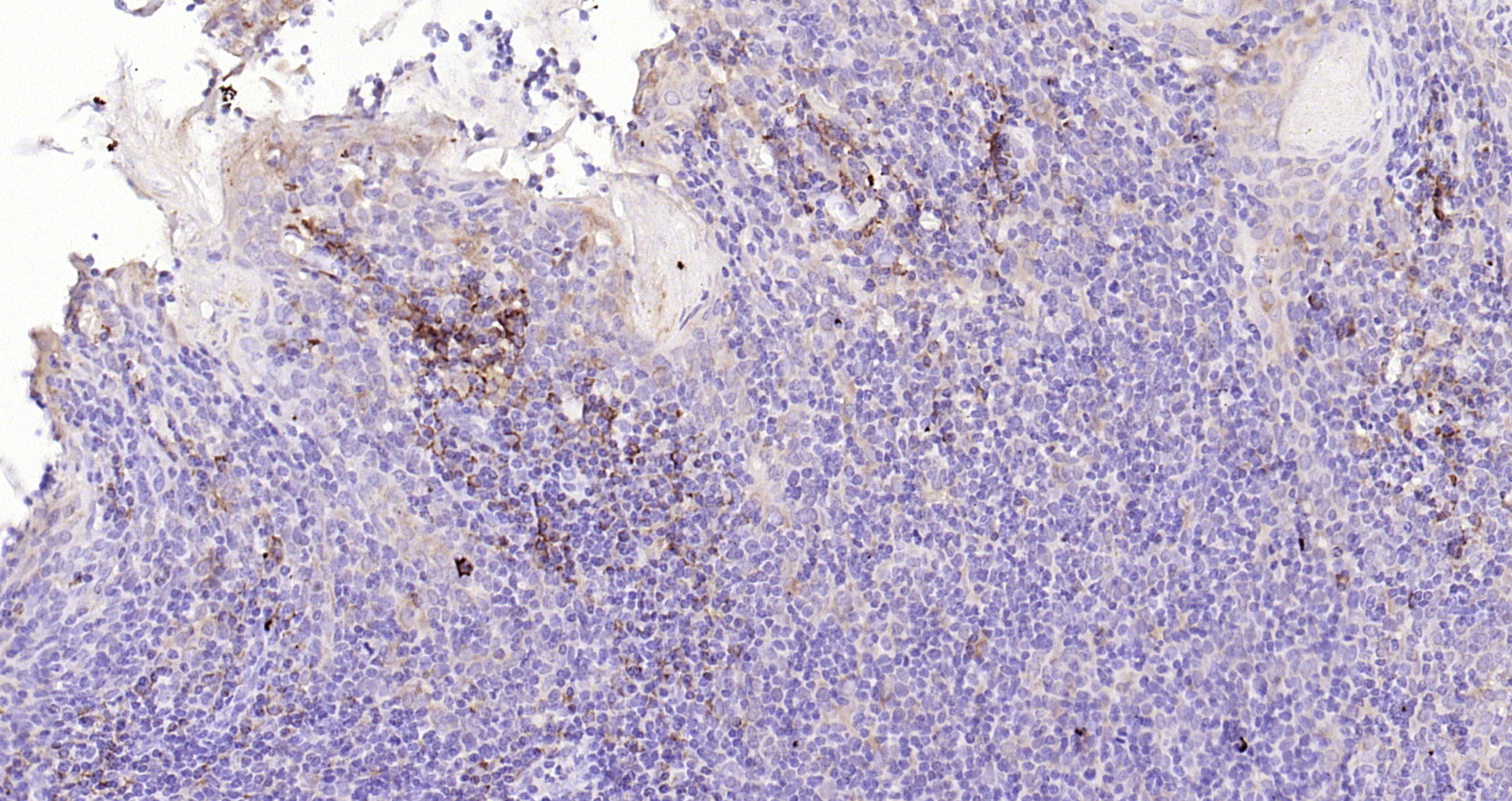 Paraformaldehyde-fixed, paraffin embedded (human tonsil); Antigen retrieval by boiling in sodium citrate buffer (pH6.0) for 15min; Block endogenous peroxidase by 3% hydrogen peroxide for 20 minutes; Blocking buffer (normal goat serum) at 37°C for 30min; Antibody incubation with (Mesothelin) Polyclonal Antibody, Unconjugated (bs-0300R) at 1:200 overnight at 4°C, followed by operating according to SP Kit(Rabbit) (sp-0023) instructionsand DAB staining.