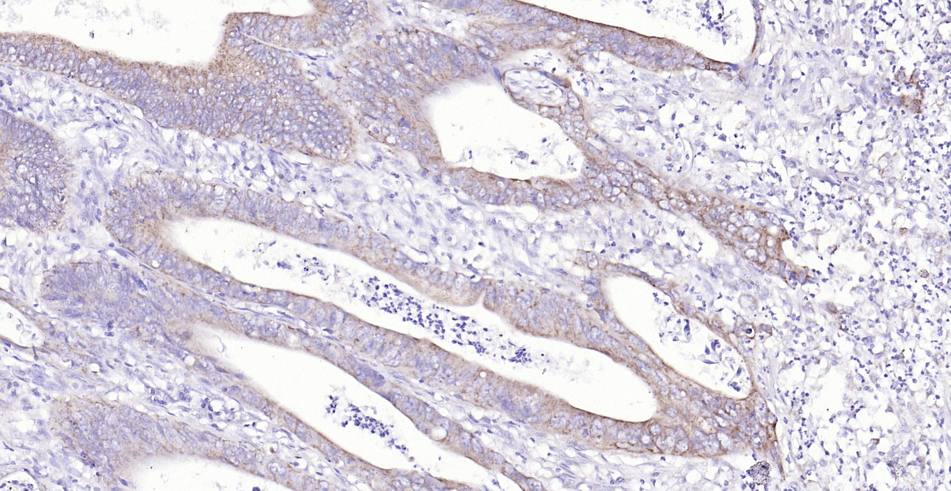 Paraformaldehyde-fixed, paraffin embedded (human colon carcinoma ）; Antigen retrieval by boiling in sodium citrate buffer (pH6.0) for 15min; Block endogenous peroxidase by 3% hydrogen peroxide for 20 minutes; Blocking buffer (normal goat serum) at 37°C for 30min; Antibody incubation with (SCD1) Polyclonal Antibody, Unconjugated (bs-3787R) at 1:200 overnight at 4°C, followed by operating according to SP Kit(Rabbit) (sp-0023) instructionsand DAB staining.