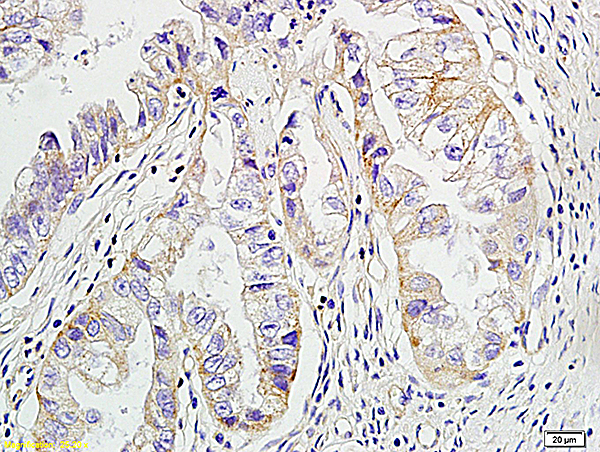 Formalin-fixed and paraffin embedded human ovarian cancer labeled with Anti-HER2 receptor(NT) Polyclonal Antibody, Unconjugated(bs-2156R) at 1:200 followed by conjugation to the secondary antibody and DAB staining