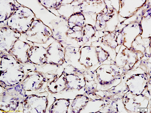 Formalin-fixed and paraffin embedded human ovarian cancer labeled with Anti-HER2 receptor(1A4) Monoclonal Antibody, Unconjugated(bsm-2156M) followed by conjugation to the secondary antibody and DAB staining Formalin-fixed and paraffin embedded human ovarian cancer labeled with Anti-HER2 receptor(1A4) Monoclonal Antibody, Unconjugated(bsm-2156M) followed by conjugation to the secondary antibody and DAB staining