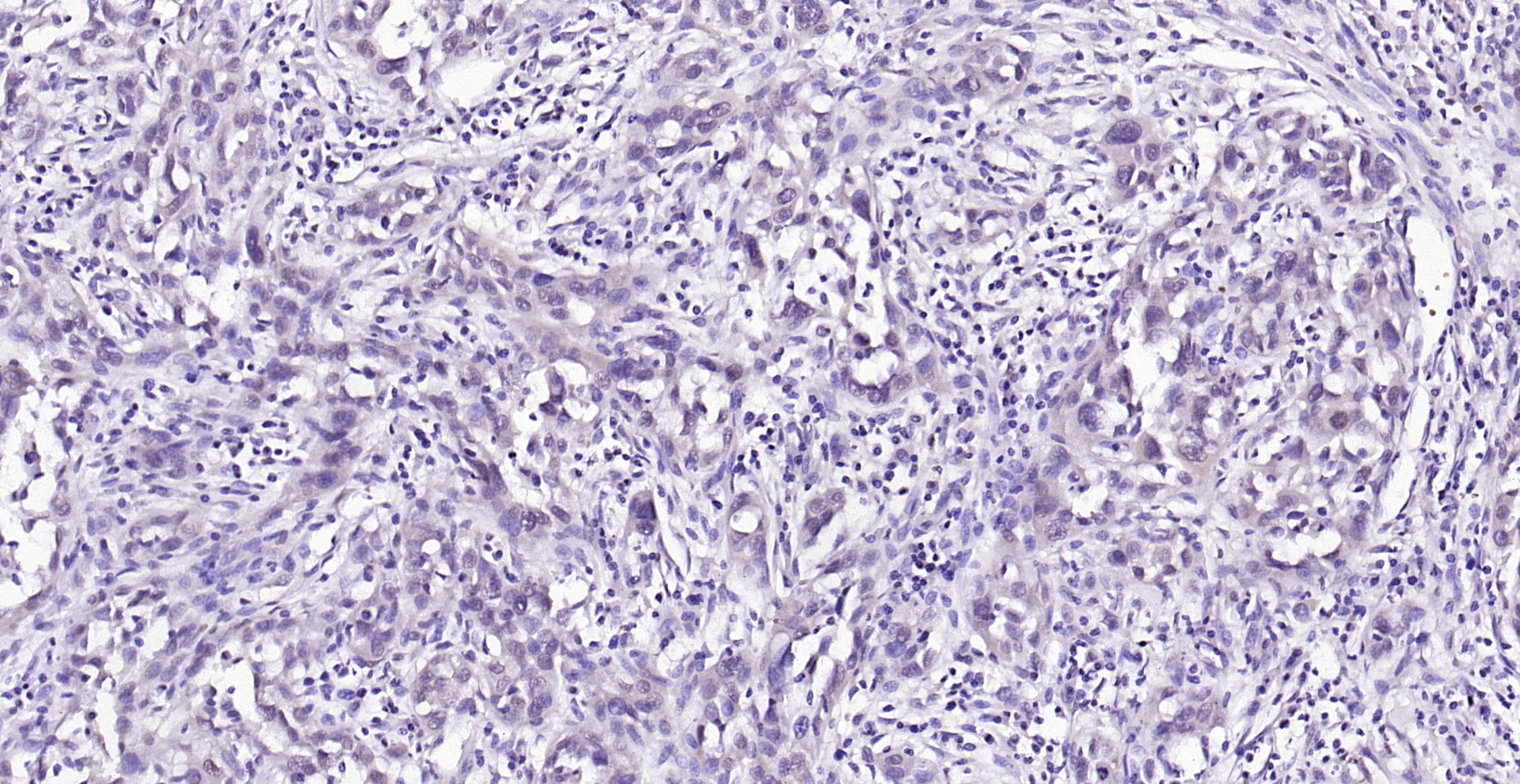 Paraformaldehyde-fixed, paraffin embedded (human gastric carcinoma); Antigen retrieval by boiling in sodium citrate buffer (pH6.0) for 15min; Block endogenous peroxidase by 3% hydrogen peroxide for 20 minutes; Blocking buffer (normal goat serum) at 37°C for 30min; Antibody incubation with (AKT (Ser473)(9H11) Monoclonal Antibody, Unconjugated (bsm-33281M) at 1:200 overnight at 4°C, followed by operating according to SP Kit(Mouse)(sp-0024) instructionsand DAB staining.