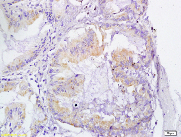 Formalin-fixed and paraffin embedded human gastric cancer labeled with Anti-VEGFR3 Polyclonal Antibody, Unconjugated (bs-2202R) at 1:200 followed by conjugation to the secondary antibody and DAB staining