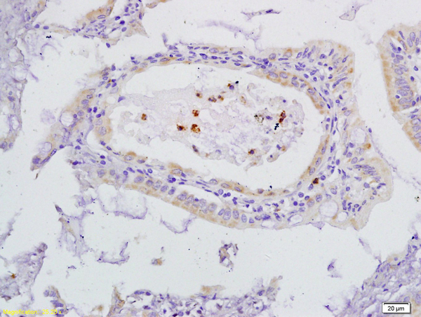 Formalin-fixed and paraffin embedded Human Gastric Cancer  labeled with VEGFR3 Polyclonal Antibody, Unconjugated (bs-2202R)  at 1:200 followed by conjugation to the secondary antibody and DAB staining
