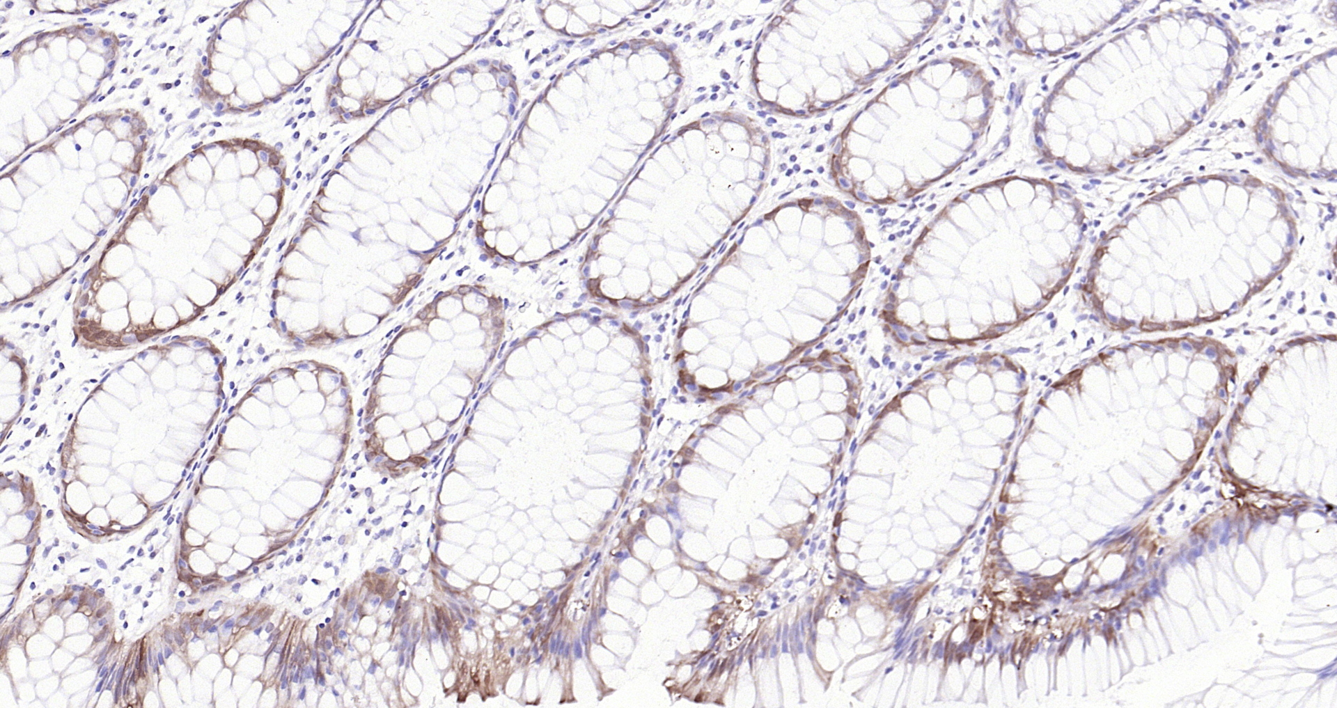 Paraformaldehyde-fixed, paraffin embedded (human colon); Antigen retrieval by boiling in sodium citrate buffer (pH6.0) for 15min; Block endogenous peroxidase by 3% hydrogen peroxide for 20 minutes; Blocking buffer (normal goat serum) at 37°C for 30min; Antibody incubation with (Adiponectin receptor 2) Polyclonal Antibody, Unconjugated (bs-0611R) at 1:200 overnight at 4°C, followed by operating according to SP Kit(Rabbit) (sp-0023) instructionsand DAB staining.