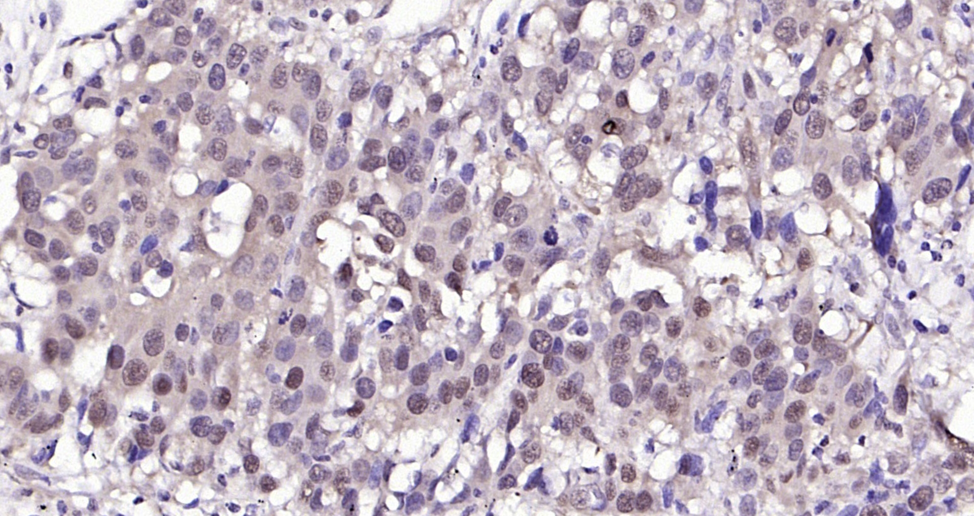 Paraformaldehyde-fixed, paraffin embedded (human lung carcinoma); Antigen retrieval by boiling in sodium citrate buffer (pH6.0) for 15min; Block endogenous peroxidase by 3% hydrogen peroxide for 20 minutes; Blocking buffer (normal goat serum) at 37°C for 30min; Antibody incubation with (HSC70) Monoclonal Antibody, Unconjugated (bsm-33211M) at 1:200 overnight at 4°C, followed by operating according to SP Kit(Mouse)(sp-0024) instructionsand DAB staining.