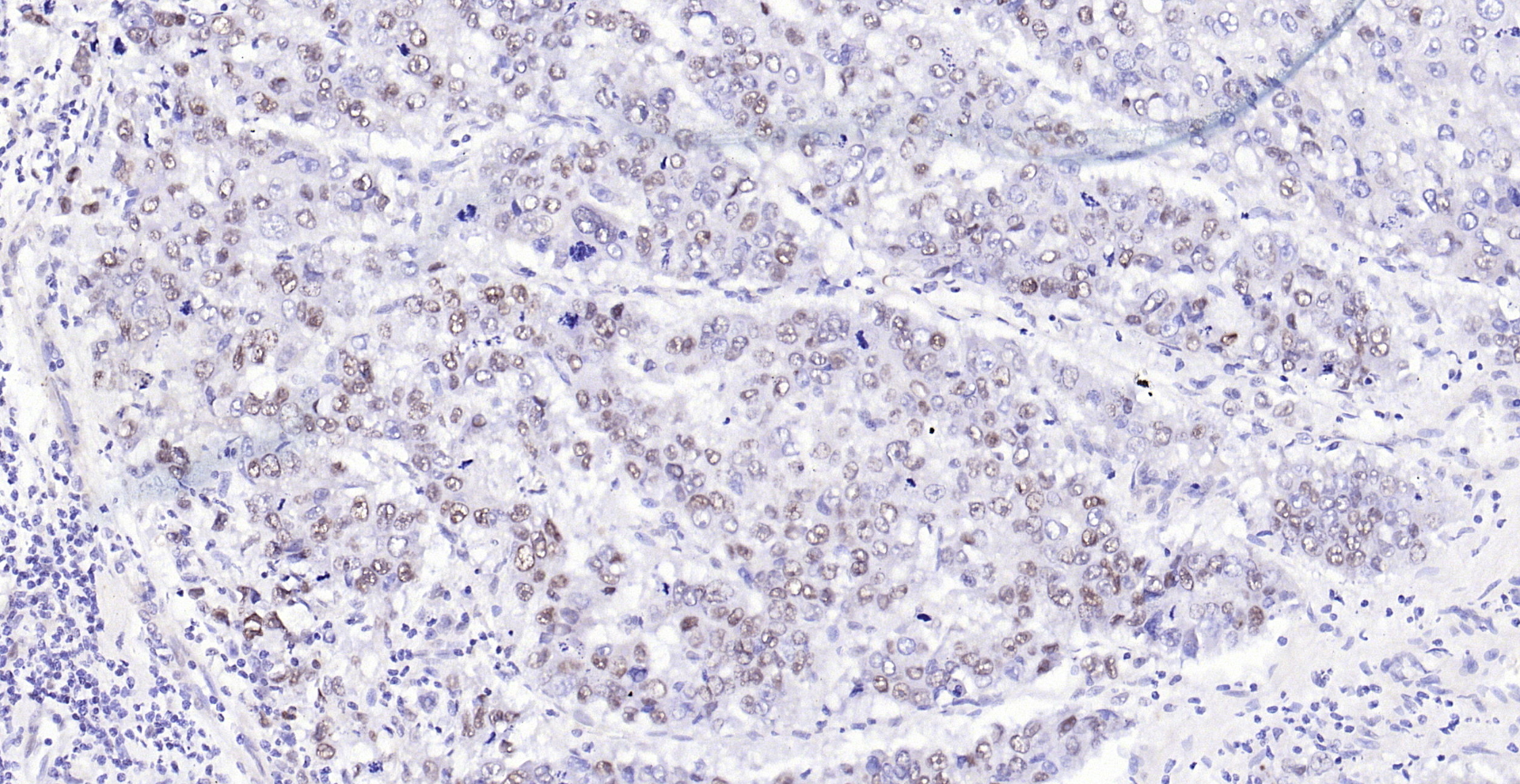 Paraformaldehyde-fixed, paraffin embedded (human liver carcinoma); Antigen retrieval by boiling in sodium citrate buffer (pH6.0) for 15min; Block endogenous peroxidase by 3% hydrogen peroxide for 20 minutes; Blocking buffer (normal goat serum) at 37°C for 30min; Antibody incubation with (SSB) Polyclonal Antibody, Unconjugated (bs-0276R) at 1:200 overnight at 4°C, followed by operating according to SP Kit(Rabbit) (sp-0023) instructionsand DAB staining.