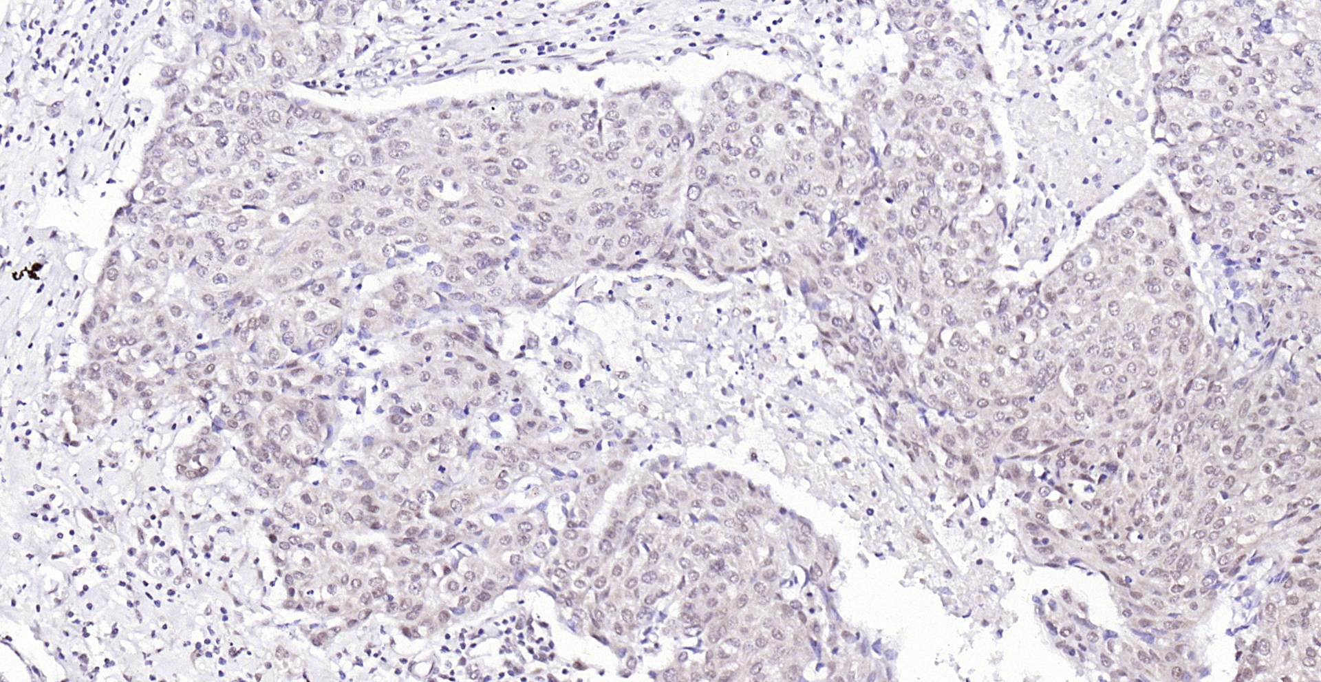 Paraformaldehyde-fixed, paraffin embedded (human breast carcinoma); Antigen retrieval by boiling in sodium citrate buffer (pH6.0) for 15min; Block endogenous peroxidase by 3% hydrogen peroxide for 20 minutes; Blocking buffer (normal goat serum) at 37°C for 30min; Antibody incubation with (SSB) Polyclonal Antibody, Unconjugated (bs-0276R) at 1:200 overnight at 4°C, followed by operating according to SP Kit(Rabbit) (sp-0023) instructionsand DAB staining.