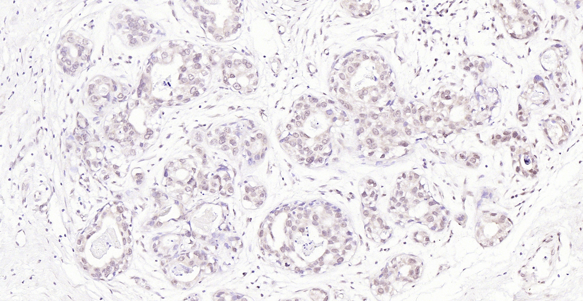 Paraformaldehyde-fixed, paraffin embedded (human breast carcinoma); Antigen retrieval by boiling in sodium citrate buffer (pH6.0) for 15min; Block endogenous peroxidase by 3% hydrogen peroxide for 20 minutes; Blocking buffer (normal goat serum) at 37°C for 30min; Antibody incubation with (FAK) Polyclonal Antibody, Unconjugated (bs-1340R) at 1:200 overnight at 4°C, followed by operating according to SP Kit(Rabbit) (sp-0023) instructionsand DAB staining.