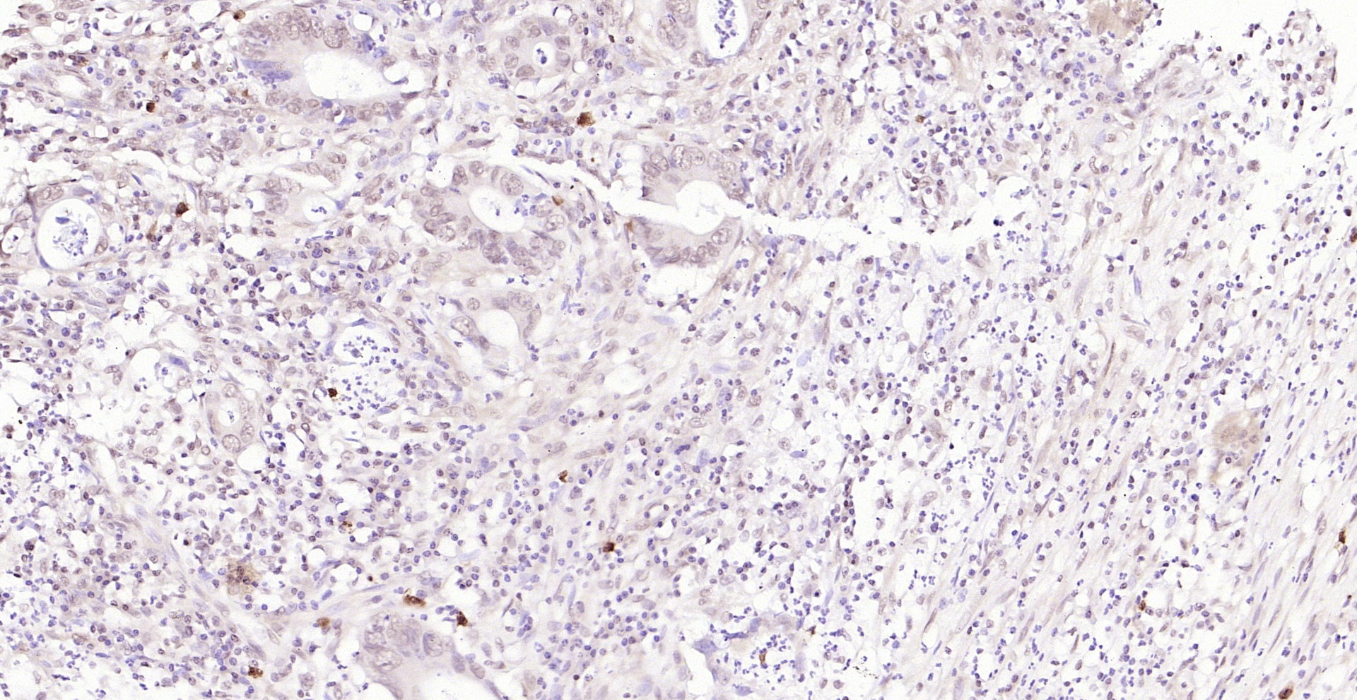 Paraformaldehyde-fixed, paraffin embedded (human colon carcinoma); Antigen retrieval by boiling in sodium citrate buffer (pH6.0) for 15min; Block endogenous peroxidase by 3% hydrogen peroxide for 20 minutes; Blocking buffer (normal goat serum) at 37°C for 30min; Antibody incubation with (FAK) Polyclonal Antibody, Unconjugated (bs-1340R) at 1:200 overnight at 4°C, followed by operating according to SP Kit(Rabbit) (sp-0023) instructionsand DAB staining.