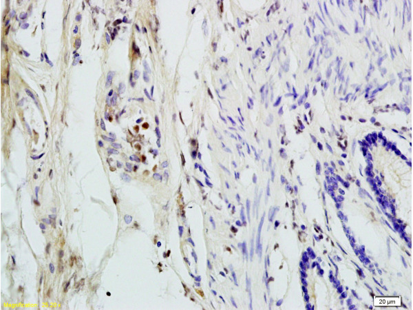 Formalin-fixed and paraffin embedded human colon carcinoma labeled with Rabbit Anti ANP32C Polyclonal Antibody, Unconjugated (bs-5927R) at 1:200 followed by conjugation to the secondary antibody and DAB staining