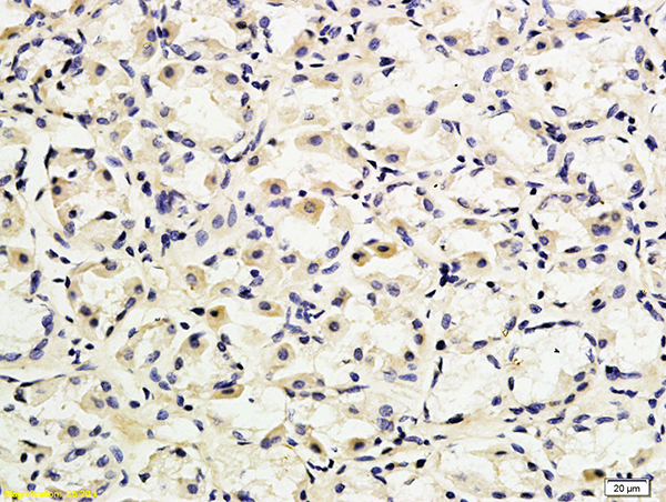 Formalin-fixed and paraffin embedded human gastric adenocarcinoma labeled with Anti-CD162 Polyclonal Antibody, Unconjugated (bs-2301R) followed by conjugation to the secondary antibody