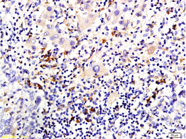 Formalin-fixed and paraffin embedded human liver carcinoma tissue labeled with Anti-P-CK\/Cytokeratin AE1+AE3 Polyclonal Antibody, Unconjugated (bs-1712R) at 1:200 followed by conjugation to the secondary antibody and DAB staining