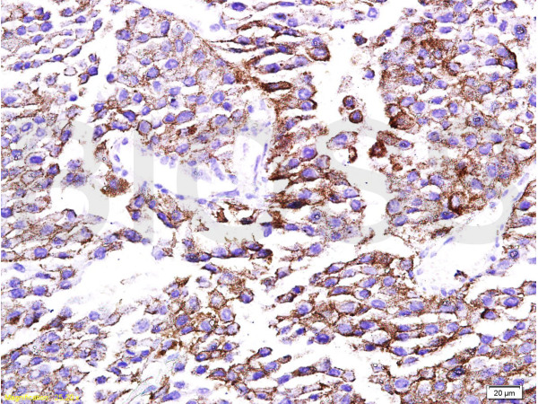 Formalin-fixed and paraffin embedded mouse melanoma tissue labeled with Anti-mTOR Polyclonal Antibody, Unconjugated(bs-1992R) at 1:200 followed by conjugation to the secondary antibody and DAB staining