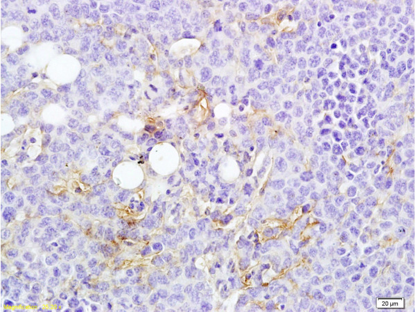 Formalin-fixed and paraffin embedded rat transplantation tumor tissue labeled with Anti-MTUS1 Polyclonal Antibody, Unconjugated (bs-6076R) at 1:200 followed by conjugation to the secondary antibody and DAB staining