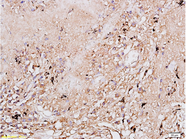 Formalin-fixed and paraffin-embedded human lung carcinoma labeled with EGFR Polyclonal Antibody, Unconjugated (bs-0165R) at 1:200 followed by conjugation to the secondary antibody and DAB staining