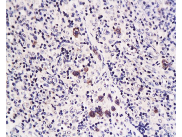 Formalin-fixed and paraffin embedded rat transplant lymphoma labeled with Anti-Caspase-1 Polyclonal Antibody, Unconjugated (bs-0169R) at 1:200 followed by conjugation to the secondary antibody and DAB staining