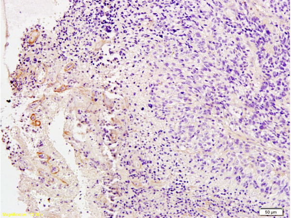 Formalin-fixed and paraffin embedded Human brain glioma labeled with Anti-PDGFRB Polyclonal Antibody, Unconjugated (bs-0232R) at 1:200 followed by conjugation to the secondary antibody and DAB staining