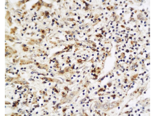 \"Formalin-fixed and paraffin embedded human liver carcinoma labeled with Anti-PLGF Polyclonal Antibody, Unconjugated (bs-0281R) at 1:200, followed by conjugation to the secondary antibody and DAB staining\\n\"