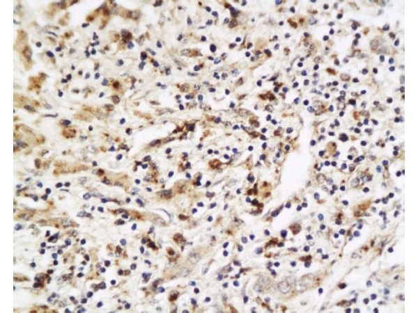 Formalin-fixed and paraffin embedded human liver carcinoma labeled with Anti-PLGF Polyclonal Antibody, Unconjugated (bs-0281R) at 1:200, followed by conjugation to the secondary antibody and DAB staining.