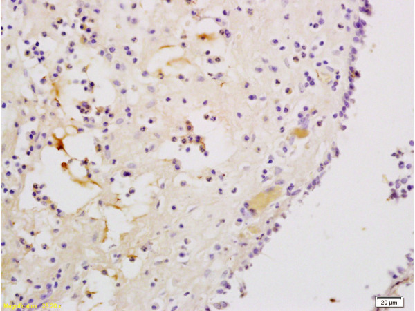 Formalin-fixed and paraffin embedded human nasal mucosa tissue labeled with Anti-CXCR3\/CD183 Polyclonal Antibody, Unconjugated (bs-0341R) at 1:200, followed by conjugation to the secondary antibody and DAB staining