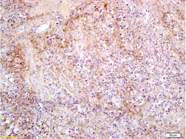 Formalin-fixed and paraffin embedded rat colon carcinoma labeled with Anti-Slc22A17 Y Polyclonal Antibody, Unconjugated (bs-0444R) at 1:300, followed by conjugation to the secondary antibody and DAB staining
