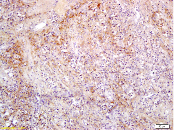 Formalin-fixed and paraffin embedded rat colon carcinoma labeled with Anti-Slc22A17 Y Polyclonal Antibody, Unconjugated (bs-0444R) at 1:300, followed by conjugation to the secondary antibody and DAB staining Formalin-fixed and paraffin embedded rat colon carcinoma labeled with Anti-Slc22A17 Y Polyclonal Antibody, Unconjugated (bs-0444R) at 1:300, followed by conjugation to the secondary antibody and DAB staining