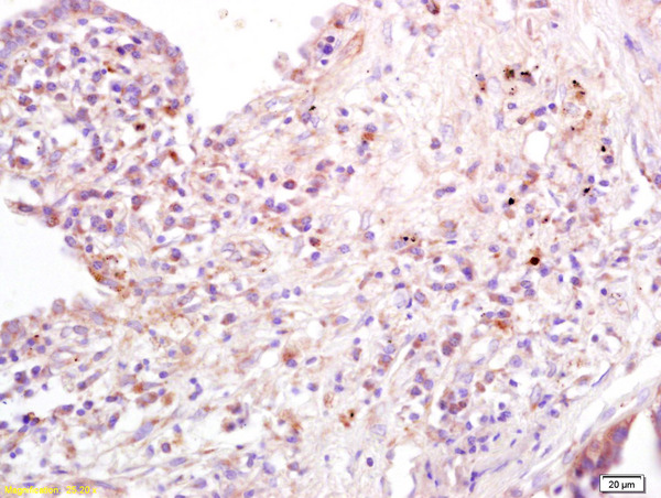 Formalin-fixed and paraffin embedded human lung carcinoma labeled with Anti-B7-1/CD80 Polyclonal Antibody, Unconjugated (bs-2211R) at 1:200 followed by conjugation to the secondary antibody and DAB staining
