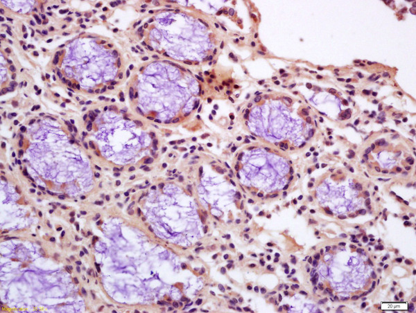 Formalin-fixed and paraffin embedded human gastric carcinoma labeled with Anti-Calponin 1/COLP Polyclonal Antibody, Unconjugated (bs-0095R) at 1:200 followed by conjugation to the secondary antibody and DAB staining