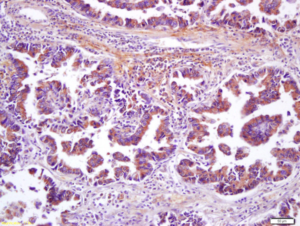Formalin-fixed and paraffin embedded human lung carcinoma labeled with Anti-Wnt8b Polyclonal Antibody, Unconjugated (bs-6245R) at 1:200 followed by conjugation to the secondary antibody and DAB staining