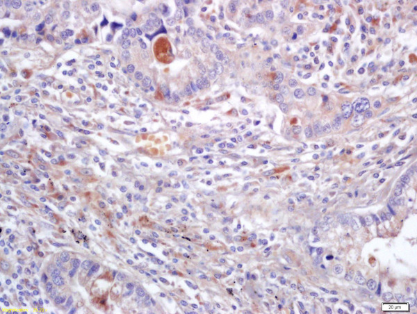 Formalin-fixed and paraffin embedded human lung carcinoma labeled with Anti-ERK2/MAPK1 Polyclonal Antibody, Unconjugated (bs-0022R) at 1:200 followed by conjugation to the secondary antibody and DAB staining