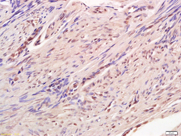 Formalin-fixed and paraffin embedded human endometrium labeled with Anti-CREB-1 Polyclonal Antibody, Unconjugated (bs-0035M) at 1:200 followed by conjugation to the secondary antibody and DAB staining