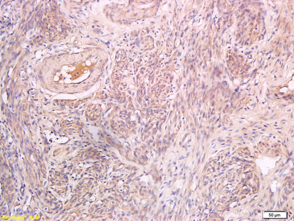 Formalin-fixed and paraffin embedded human endometrial carcinoma labeled with Anti-Inhibin beta B Polyclonal Antibody, Unconjugated (bs-1825R) at 1:200 followed by conjugation to the secondary antibody and DAB staining