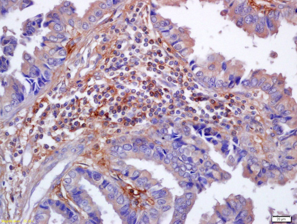 Formalin-fixed and paraffin embedded human lung carcinoma labeled with Anti-phospho-Nrf2 (Ser40) Polyclonal Antibody, Unconjugated (bs-2013R) at 1:200 followed by conjugation to the secondary antibody and DAB staining