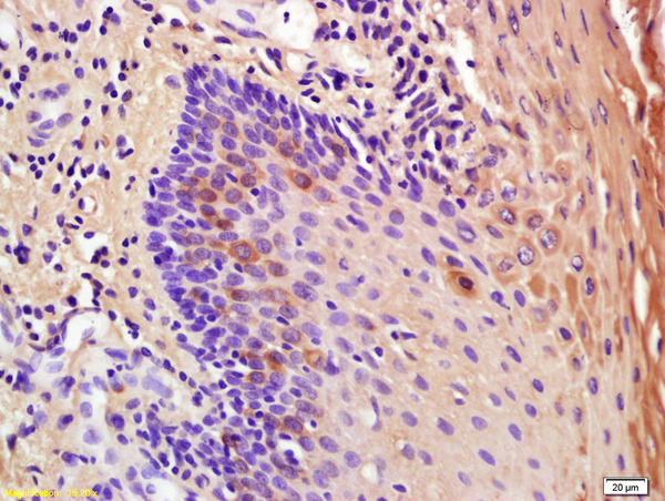 Formalin-fixed and paraffin embedded human oral squamous cell carcinoma labeled with Anti-IL-1RA Polyclonal Antibody, Unconjugated (bs-2216R) at 1:200 followed by conjugation to the secondary antibody and DAB staining