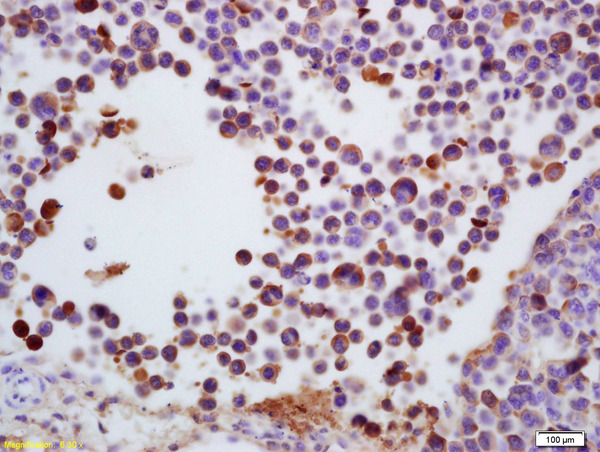 Formalin-fixed and paraffin embedded mouse colon carcinoma labeled with Anti-TdT/DNTT Polyclonal Antibody, Unconjugated (bs-2938R) at 1:200 followed by conjugation to the secondary antibody and DAB staining