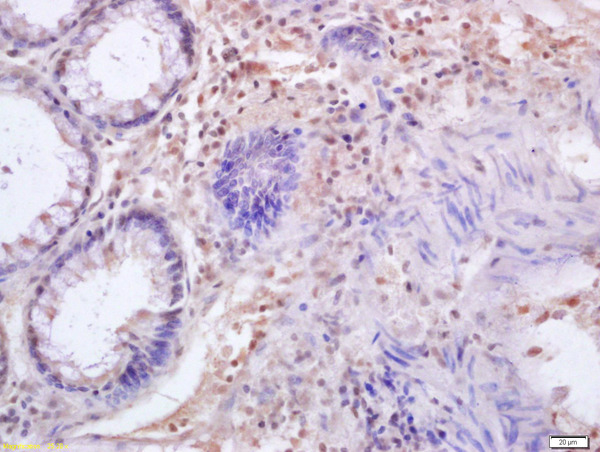 Formalin-fixed and paraffin embedded human colon carcinoma labeled with Anti-IRF3 Polyclonal Antibody, Unconjugated (bs-2993R) at 1:200 followed by conjugation to the secondary antibody and DAB staining