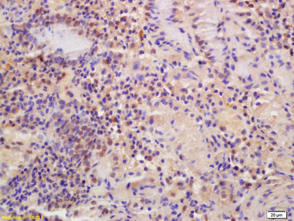 Formalin-fixed and paraffin embedded human gastric carcinoma labeled with Anti-MTF-1 Polyclonal Antibody, Unconjugated (bs-3601R) at 1:200 followed by conjugation to the secondary antibody and DAB staining