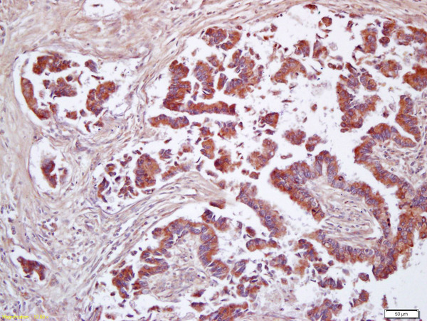 Formalin-fixed and paraffin embedded human lung carcinoma labeled with Anti-CD200\/MOX1 Polyclonal Antibody, Unconjugated (bs-6030R) at 1:200 followed by conjugation to the secondary antibody and DAB staining