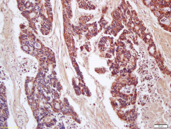 Formalin-fixed and paraffin embedded human colon carcinoma labeled with Anti-CD200/MOX1 Polyclonal Antibody, Unconjugated (bs-6030R) at 1:200 followed by conjugation to the secondary antibody and DAB staining