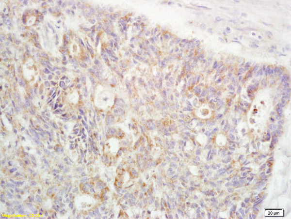 Formalin-fixed and paraffin embedded human rectal carcinoma labeled with Anti-RanBP1 Polyclonal Antibody, Unconjugated (bs-9322R) at 1:200 followed by conjugation to the secondary antibody and DAB staining