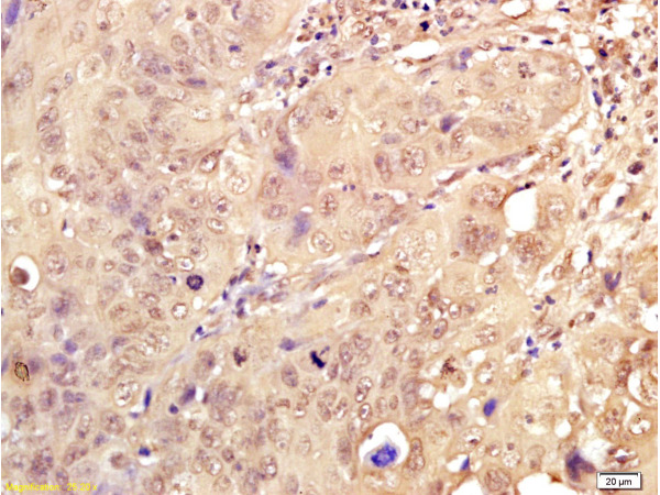 Formalin-fixed and paraffin embedded human breast carcinoma labeled with Anti-Dnmt3a Polyclonal Antibody, Unconjugated (bs-0497R) at 1:200, followed by conjugation to the secondary antibody and DAB staining