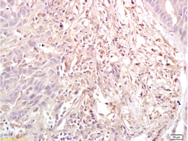 Formalin-fixed and paraffin embedded human gastric carcinoma labeled with Anti-Dnmt3a Polyclonal Antibody, Unconjugated (bs-0497R) at 1:200, followed by conjugation to the secondary antibody and DAB staining
