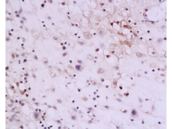Formalin-fixed and paraffin embedded human placenta tissue labeled with Anti-IL-13 Polyclonal Antibody, Unconjugated (bs-0560R) at 1:200, followed by conjugation to the secondary antibody and DAB staining