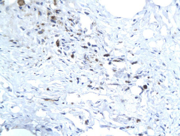 Formalin-fixed and paraffin embedded human liver labeled with Anti-Hepatitis E Virus ORF3 Polyclonal Antibody, Unconjugated (bs-0212R)  followed by conjugation to the secondary antibody and DAB staining