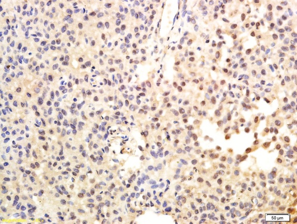 Formalin-fixed and paraffin embedded human hepatoma labeled with Anti-TRT/TERT Polyclonal Antibody, Unconjugated (bs-0233R) followed by conjugation to the secondary antibody and DAB staining