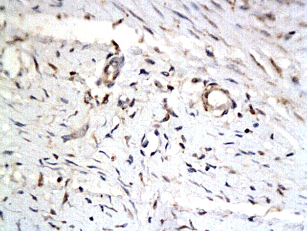 Formalin-fixed and paraffin embedded keloid tissue labeled with Anti-iASPP Polyclonal Antibody, Unconjugated (bs-0284R) followed by conjugation to the secondary antibody and DAB staining