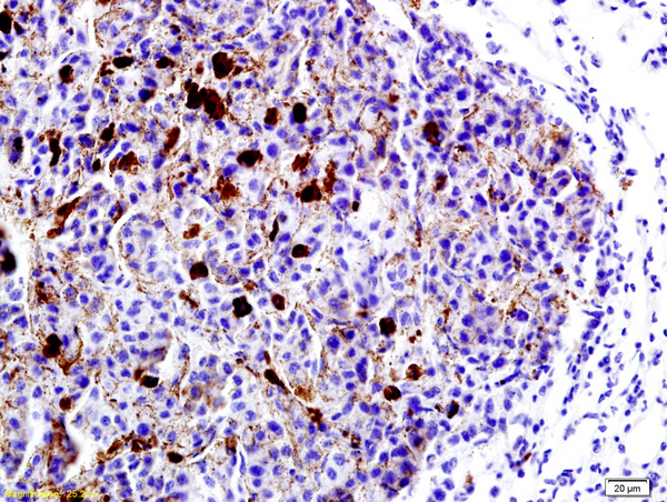 Formalin-fixed and paraffin embedded mouse lung cancer labeled with Anti-LRP1/CD91 Polyclonal Antibody, Unconjugated (bs-2677R) at 1:200 followed by conjugation to the secondary antibody and DAB staining