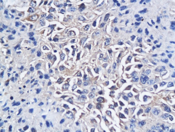Formalin-fixed and paraffin embedded mouse hepatic tumor labeled with Anti-CD150\/SLAMF1 Polyclonal Antibody, Unconjugated(bs-2709R) followed by conjugation to the secondary antibody and DAB staining