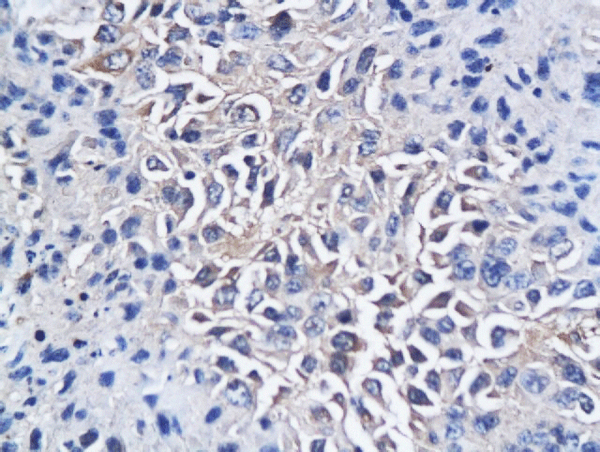 Formalin-fixed and paraffin embedded mouse hepatic tumor labeled with Anti-CD150/SLAMF1 Polyclonal Antibody, Unconjugated(bs-2709R) followed by conjugation to the secondary antibody and DAB staining Formalin-fixed and paraffin embedded mouse hepatic tumor labeled with Anti-CD150/SLAMF1 Polyclonal Antibody, Unconjugated(bs-2709R) followed by conjugation to the secondary antibody and DAB staining