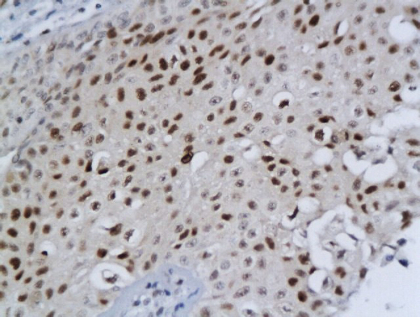 Formalin-fixed and paraffin embedded human bladder cancer labeled with Anti-DBC1/DELETED IN BLADDER CANCER 1 Polyclonal Antibody, Unconjugated (bs-2761R) followed by conjugation to the secondary antibody and DAB staining